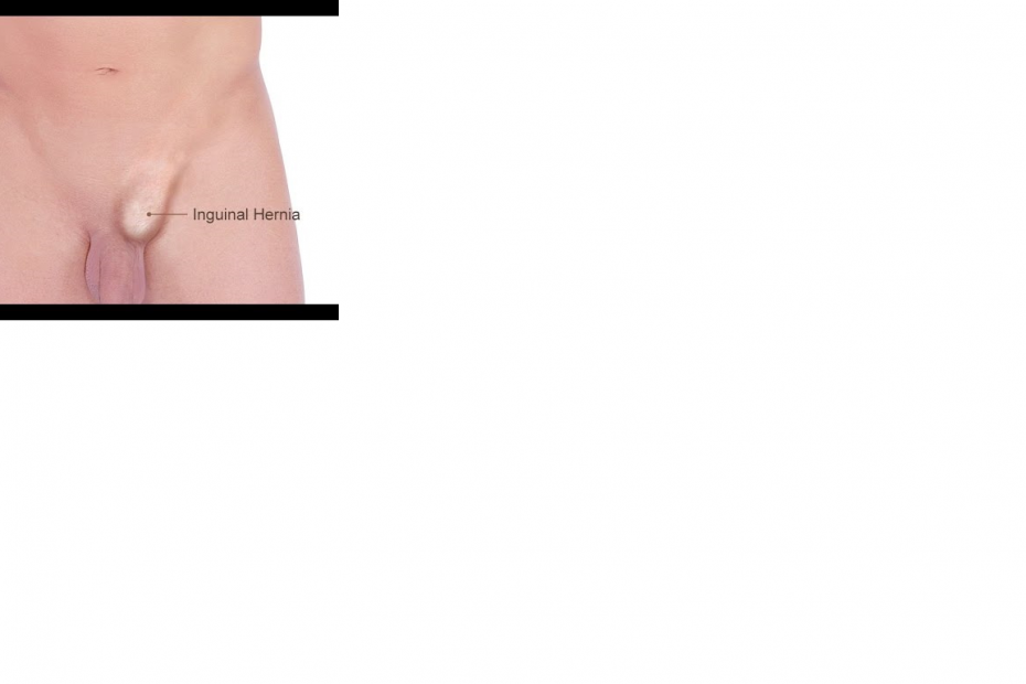 Inguinal Hernia